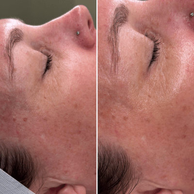 ANTI-AGING FACIALS